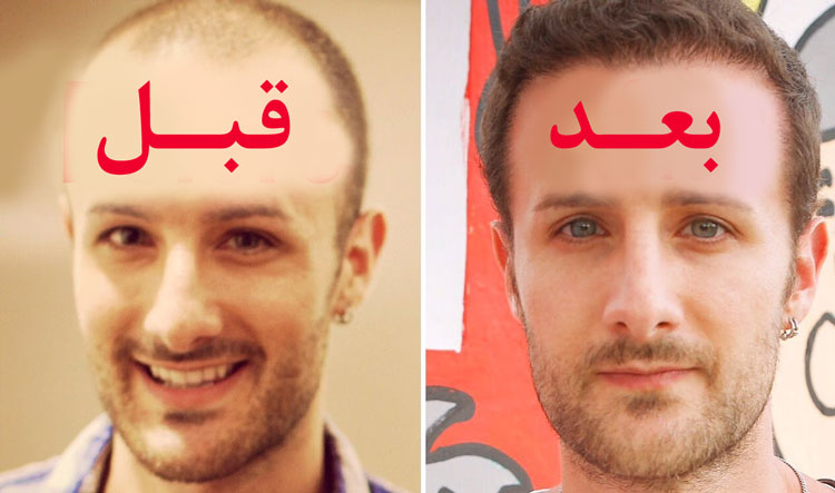 کاشت مو، عوارض و مراقبتهای بعد از کاشت مو کاشت مو، عوارض و مراقبتهای بعد از کاشت مو