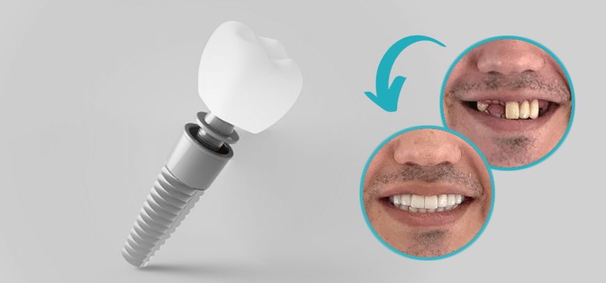 بریج بهتر است یا ایمپلنت ؟ بریج بهتر است یا ایمپلنت ؟