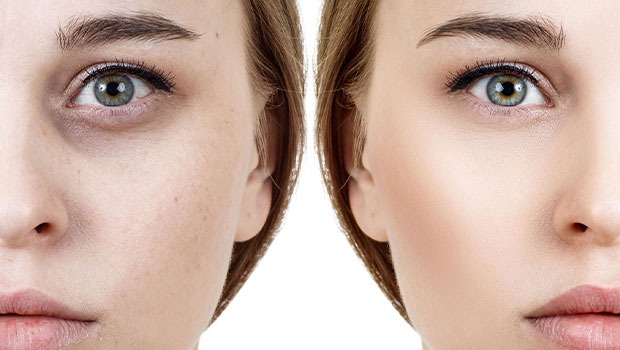 تیرگی زیر چشم تیرگی زیر چشم