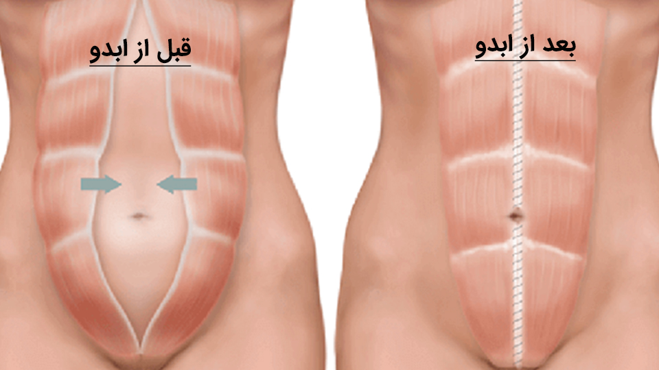 ابدومینوپلاستی جراحی زیبایی شکم