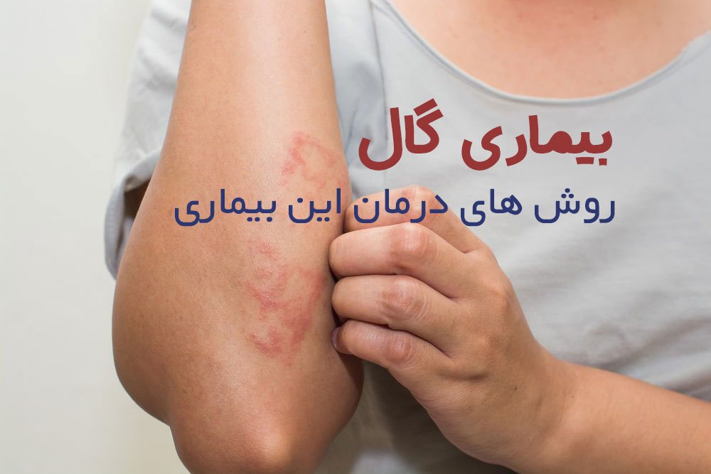 بیماری گال