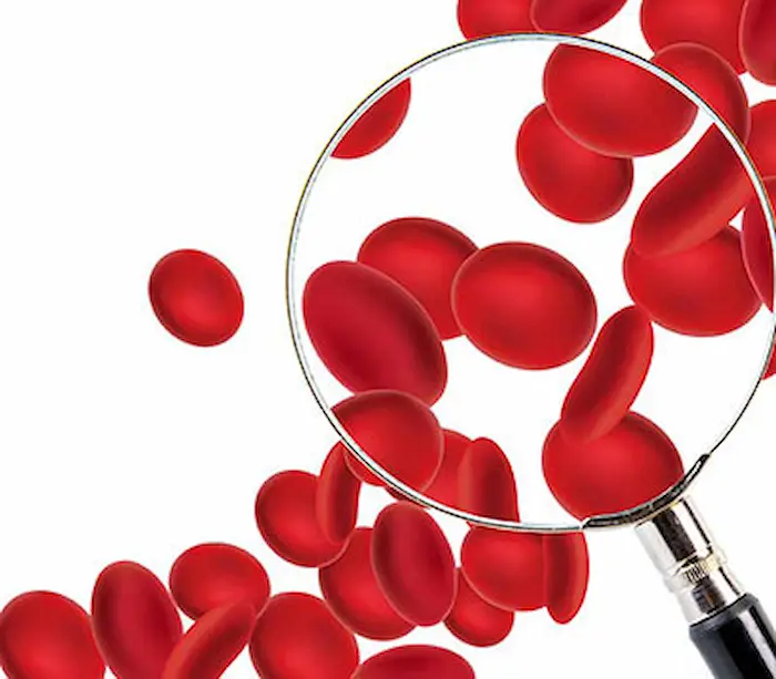کم خونی داسی شکل کودک؛ علائم و روش های درمان این نوع کم خونی 8 کم خونی داسی شکل کودک؛ علائم و روش های درمان این نوع کم خونی