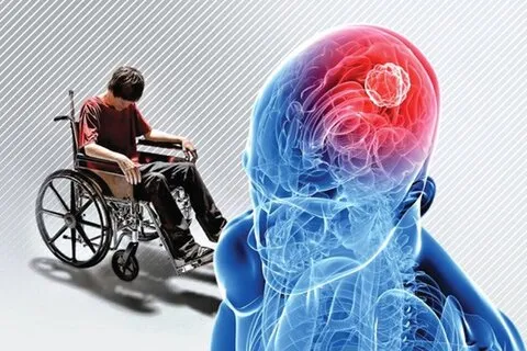 همه چیز درباره بیماری ام اس؛ علائم و نحوه درمان و راهکارهای کنترل MS 1 1716471 1