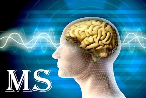 همه چیز درباره بیماری ام اس؛ علائم و نحوه درمان و راهکارهای کنترل MS 3 unnamed
