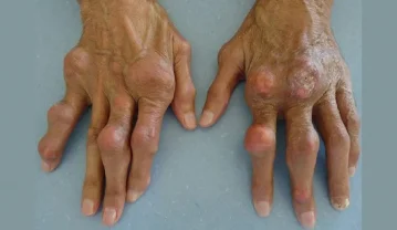 همه چیز درباره بیماری نقرس یا Gout (دلیل ایجاد، پیشگیری و درمان) نقرس
