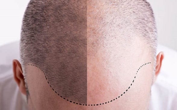 چرا هزینه کاشت مو در مناطق مختلف متفاوت است؟ 2 چرا هزینه کاشت مو در مناطق مختلف متفاوت است؟