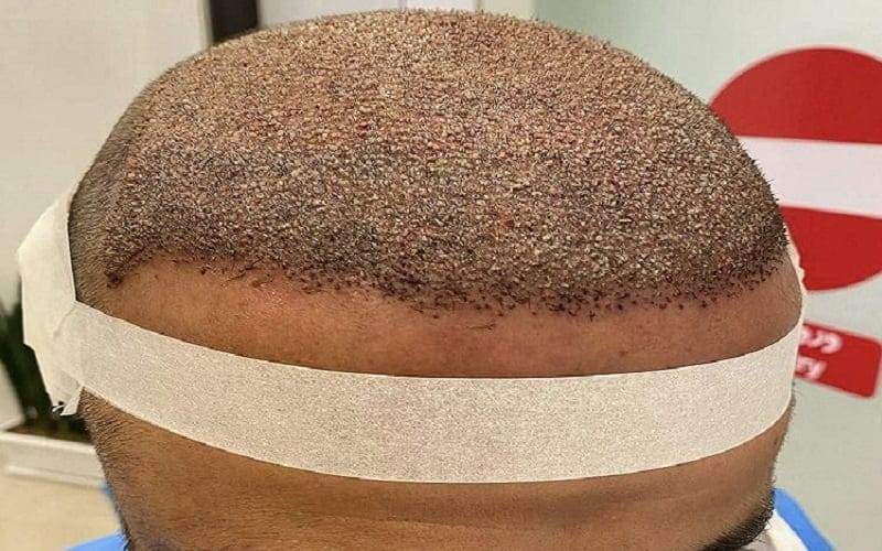 چرا هزینه کاشت مو در مناطق مختلف متفاوت است؟ 3 چرا هزینه کاشت مو در مناطق مختلف متفاوت است؟