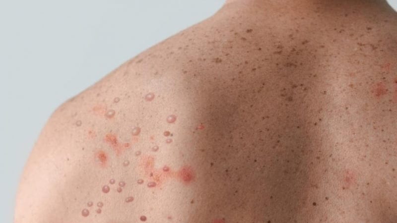 تعبیر خواب آبله؛ دیدن آبله در خواب چه تعابیری دارد و به چه معناست؟ 3 تعبیر خواب آبله؛ دیدن آبله در خواب چه تعابیری دارد و به چه معناست؟