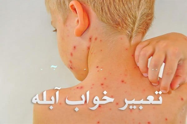تعبیر خواب آبله؛ دیدن آبله در خواب چه تعابیری دارد و به چه معناست؟ 1 تعبیر خواب آبله؛ دیدن آبله در خواب چه تعابیری دارد و به چه معناست؟