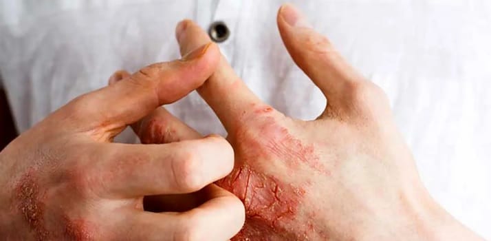 بیماری سلیاک چیست؟ همه چیز در مورد عدم تحمل گلوتن 3 3 5