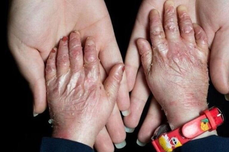 همه چیز در مورد بیماری پروانه ای؛ علائم، انواع بیماری و راهکارهای درمانی 4 همه چیز در مورد بیماری پروانه ای؛ علائم، انواع بیماری و راهکارهای درمانی