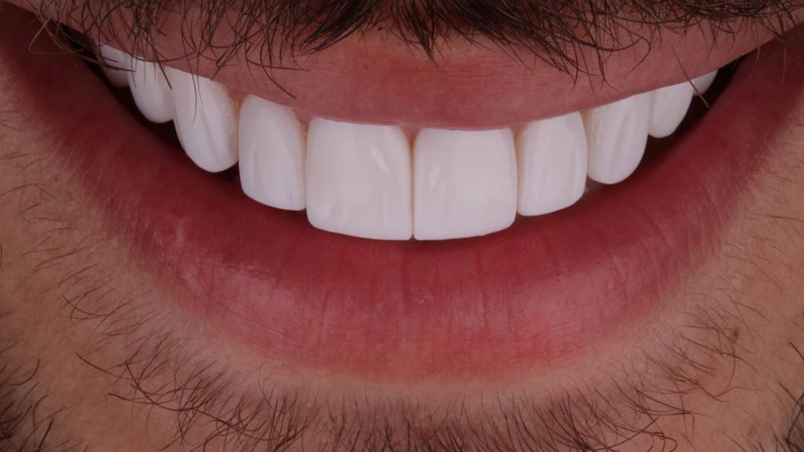 تفاوت لمینت و کامپوزیت؛ مقایسه ویژگی ها و نحوه انجام 1 0 2
