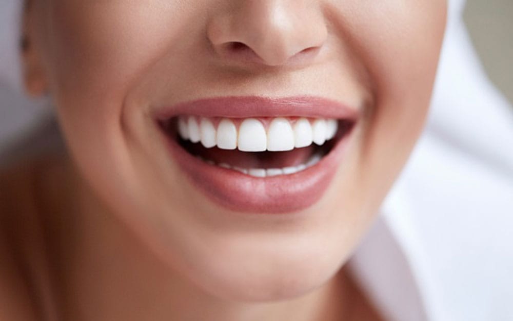 تفاوت لمینت و کامپوزیت؛ مقایسه ویژگی ها و نحوه انجام 2 dental laminate min 1