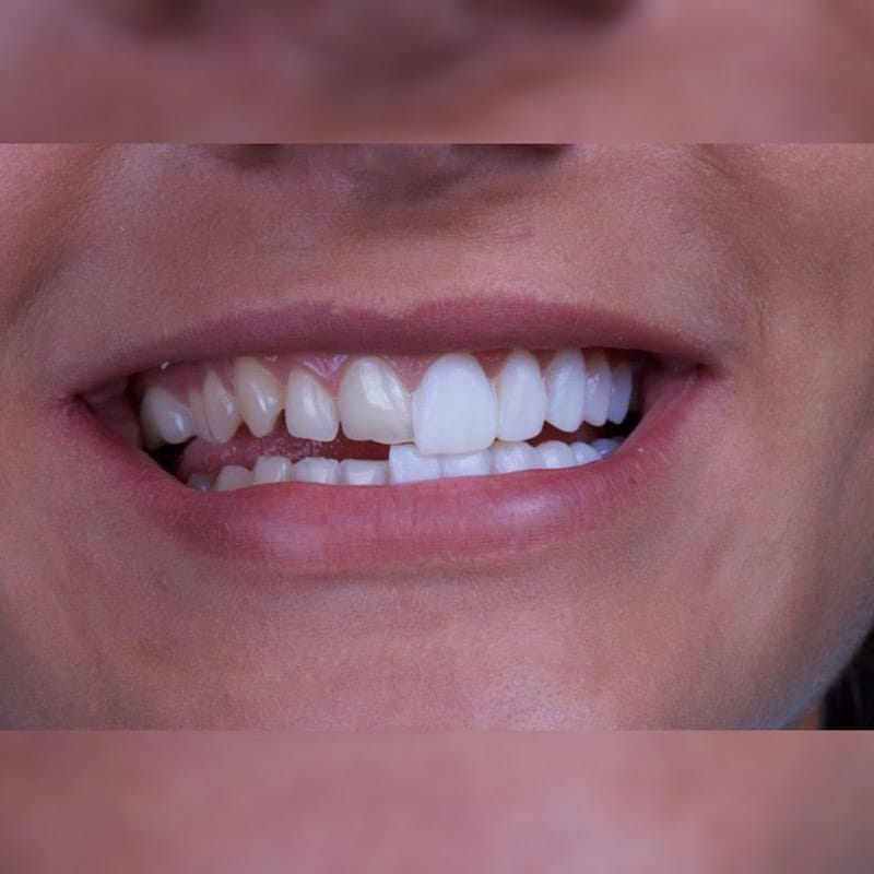 تفاوت لمینت و کامپوزیت؛ مقایسه ویژگی ها و نحوه انجام 6 فرق لمینت وکامپوزیت