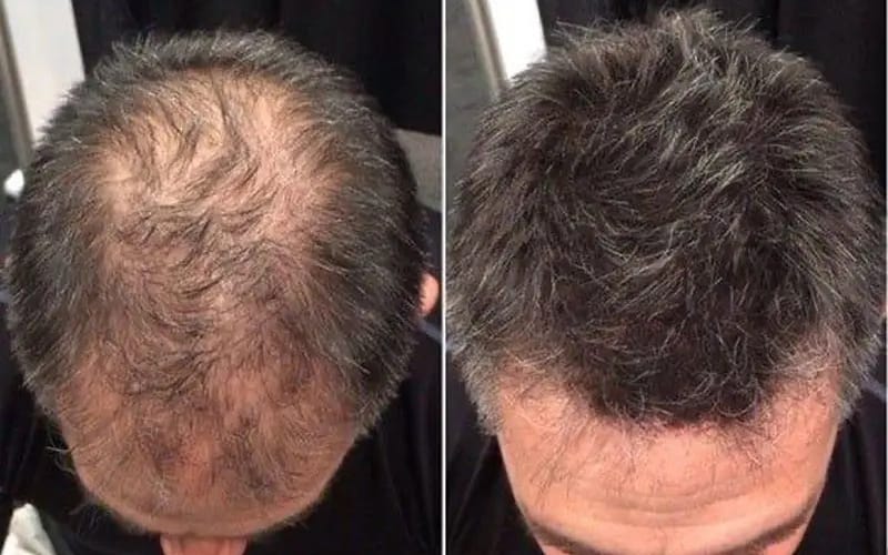 کاشت مو: راهکاری دائمی برای مقابله با ریزش مو 1 کاشت مو کلینیک مهرزاد