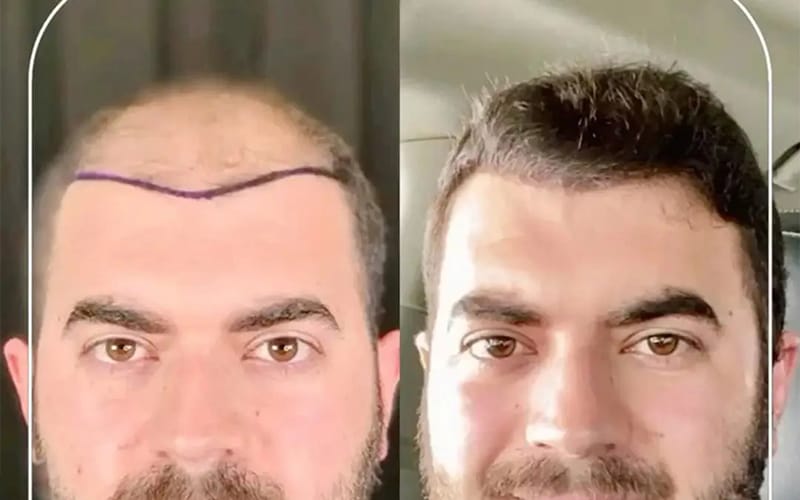 کاشت مو: راهکاری دائمی برای مقابله با ریزش مو 2 کاشت مو در کلینیک مهرزاد