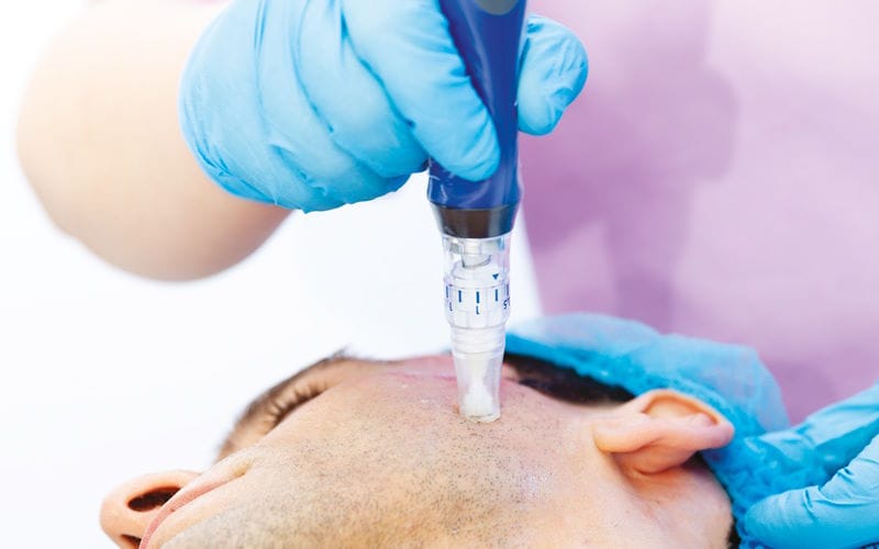 اسید تراپی چیست؟ انواع اسید تراپی برای زیبایی و سلامت پوست 4 نقش اسید تراپی در کاهش آکنه و کنترل چربی پوست