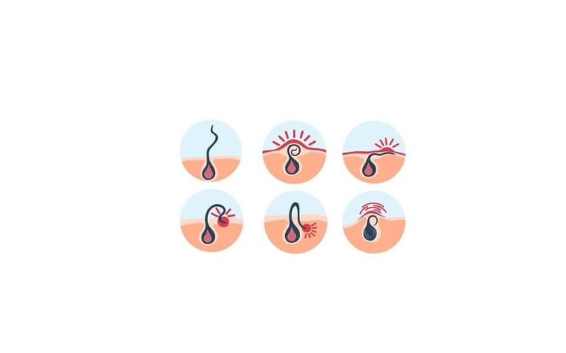 زگیل تناسلی و همه چیز در مورد این زائده های ناحیه تناسلی و درمان آن 1 Genital Warts
