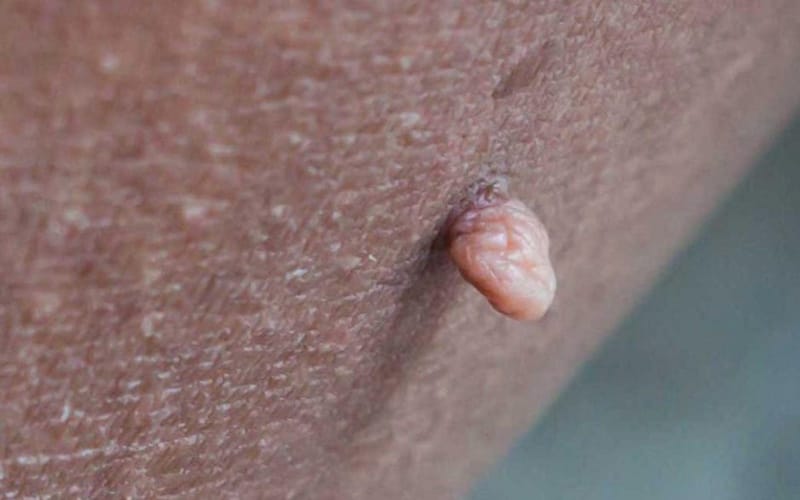 زگیل تناسلی و همه چیز در مورد این زائده های ناحیه تناسلی و درمان آن 4 HPV