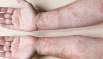 اگزما چیست و چطور به آن دچار می شویم؟ نشانه ها و روش درمان اگزما