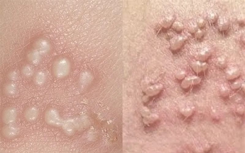 زگیل تناسلی و همه چیز در مورد این زائده های ناحیه تناسلی و درمان آن 2 علائم زگیل تناسلی در زنان و مردان