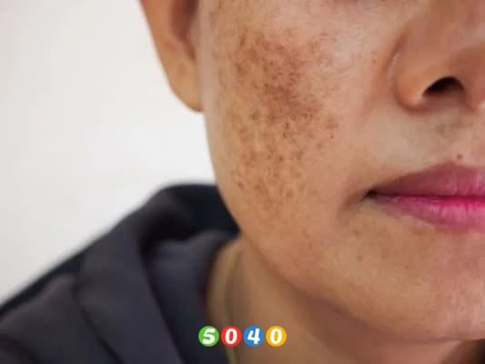 رفع لکهای تیره پوست با این راهکار گیاهی 1 کرم ضدلک-5040