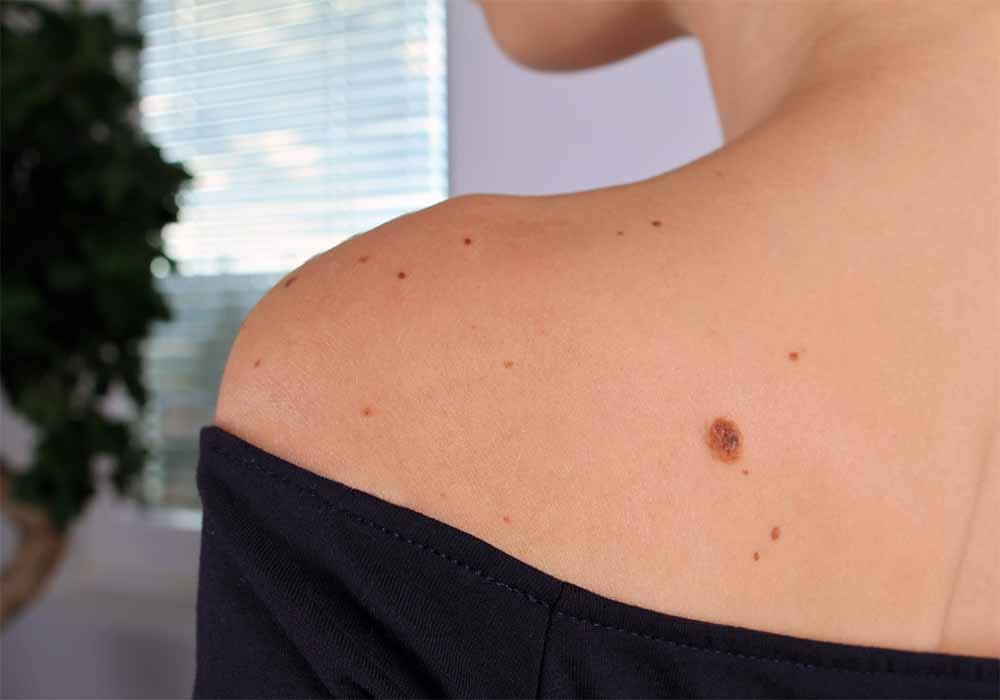 خال سرطانی؛ علائم خال های سرطانی، تشخیص و انواع روش های درمان