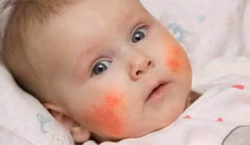 آلرژی غذایی کودکان؛ روش های تشخیص، علائم و مدیریت آلرژی نوزاد و کودک آلرژی غذایی کودکان