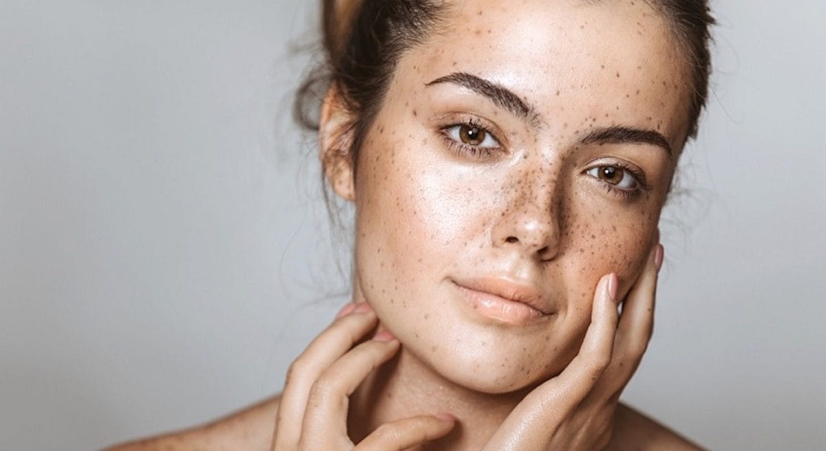 از بین بردن لک صورت با ۷ روش خانگی شگفتانگیز + درمانهای تخصصی 1 از بین بردن لک صورت با ۷ روش خانگی شگفتانگیز + درمانهای تخصصی