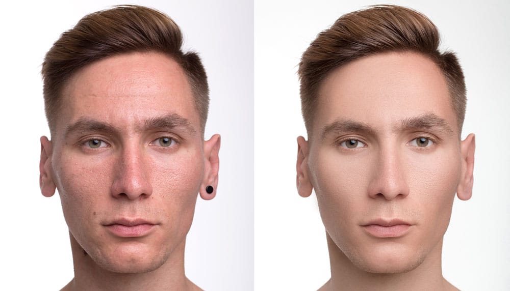 آیا بوتاکس باعث پر شدن صورت میشود ؟ درک تفاوت و کاربرد ها 1 آیا بوتاکس باعث پر شدن صورت میشود ؟ درک تفاوت و کاربرد ها