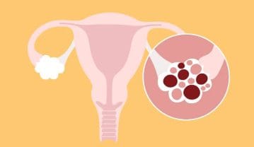 سندروم تخمدان پلی کیستیک (PCOS) و روش های درمان سندروم تخمدان پلی کیستیک