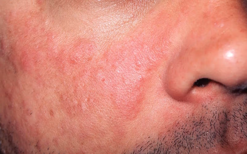لوپوس پوستی و حساسیت به تغییرات آب وهوایی