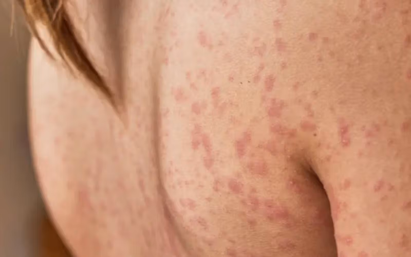 کهیر و واکنش های آلرژیک در فصل پاییز