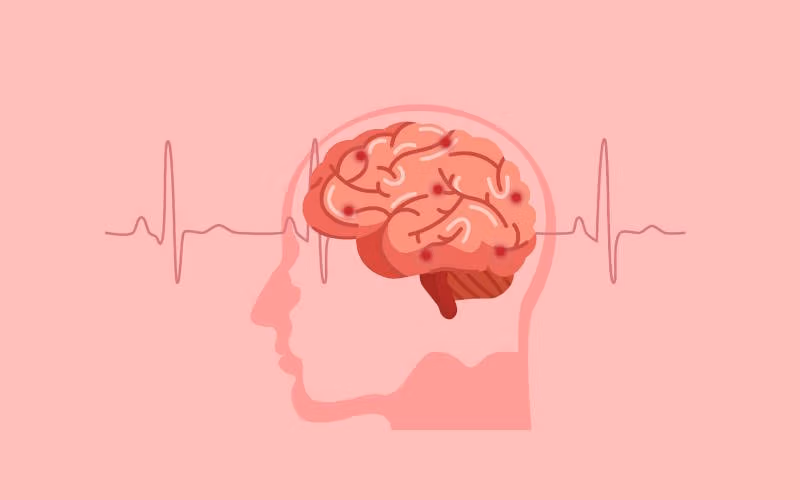 نشانه ها و علائم اولیه سکته مغزی