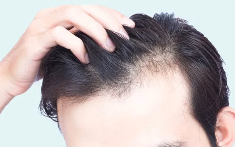 پیشگیری ریزش موی ارثی؛ روش های درمان و کنترل 1 تفاوت ریزش موی ارثی و هورمونی