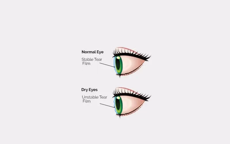 خشکی چشم چیست؟ روش پیشگیری و درمان (عوارض خشکی) 2 روش های درمان و کنترل خشکی چشم