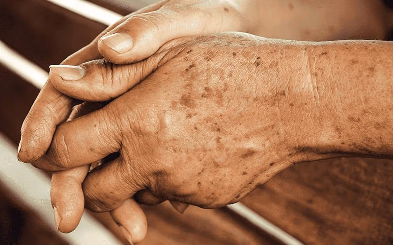 علت پیدایش لکه های پیری