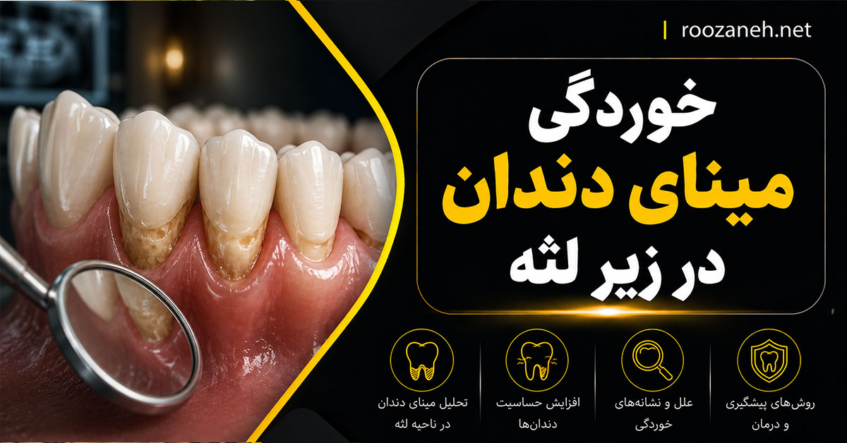 خوردگی مینای دندان در زیر لثه؛ علت، علائم، درمان و راههای پیشگیری 1 خوردگی مینای دندان در زیر لثه؛ علت، علائم، درمان و راههای پیشگیری