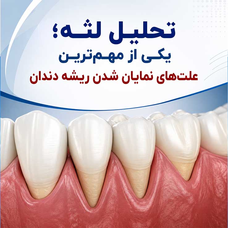 خوردگی مینای دندان در زیر لثه؛ علت، علائم، درمان و راههای پیشگیری 3 تحلیل لثه؛ یکی از مهمترین علتهای نمایان شدن ریشه دندان