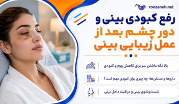 رفع کبودی بینی و دور چشم بعد از عمل زیبایی بینی