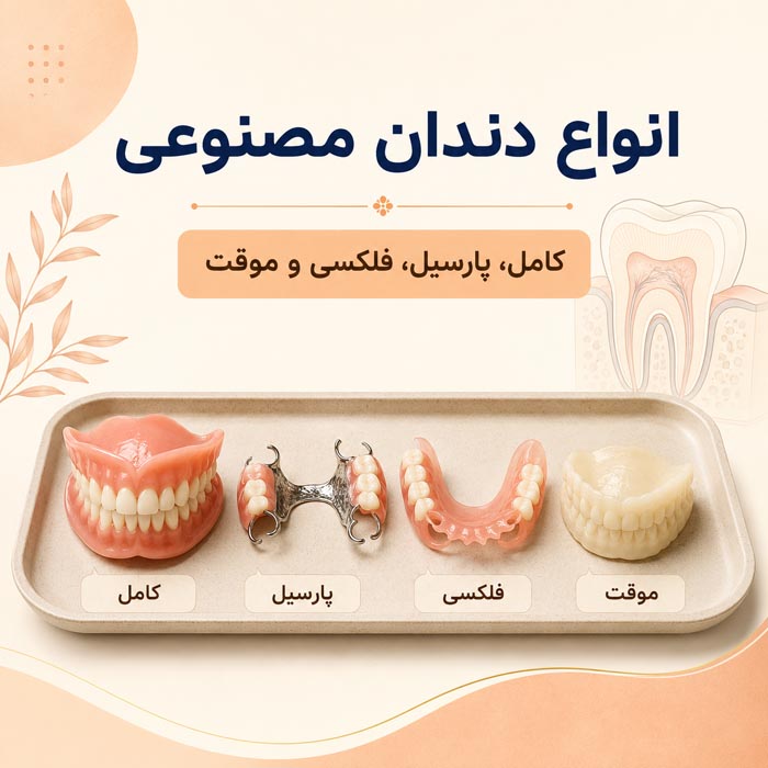 انواع دندان مصنوعی؛ راهنمای کامل انتخاب، نصب و هزینهها 5 مراحل قالبگیری و ساخت دندان مصنوعی