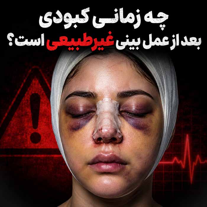 رفع کبودی بینی و دور چشم بعد از عمل زیبایی بینی؛ مراقبتها، زمان بهبود و نکات مهم 7 چه زمانی کبودی بعد از عمل بینی غیرطبیعی است؟