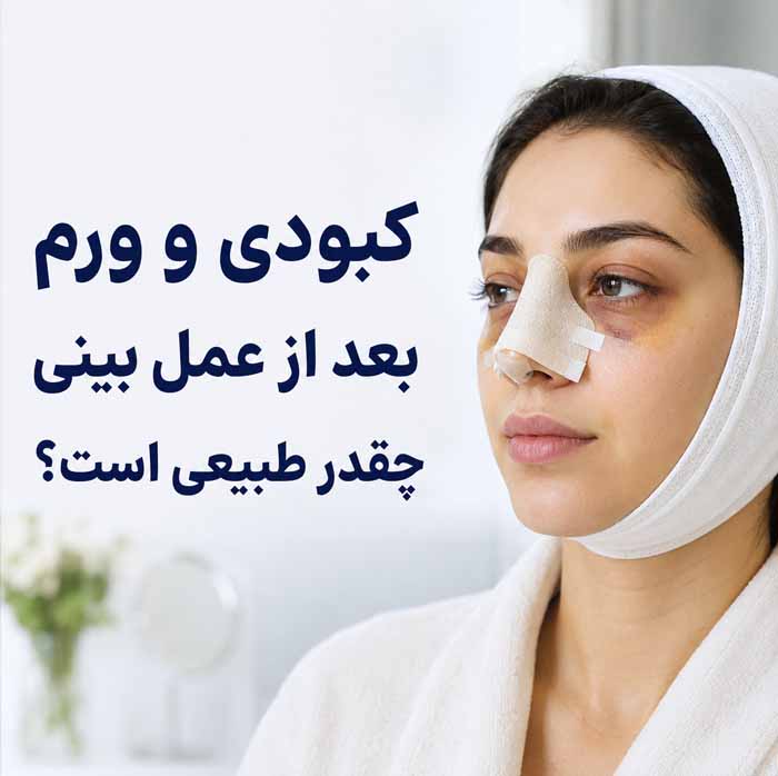 رفع کبودی بینی و دور چشم بعد از عمل زیبایی بینی؛ مراقبتها، زمان بهبود و نکات مهم 2 کبودی و ورم بعد از عمل بینی چقدر طبیعی است؟