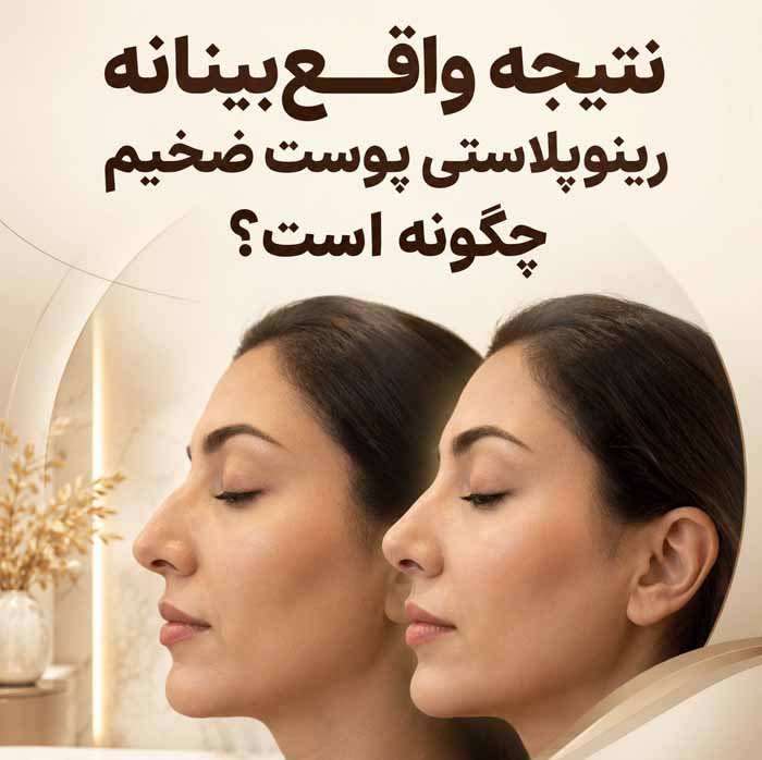 رینوپلاستی پوست ضخیم؛ نتیجه عمل بینی گوشتی و مدت ماندگاری ورم؛ مراقبتها و انتظارات واقعبینانه 3 نتیجه واقعبینانه رینوپلاستی پوست ضخیم چگونه است؟