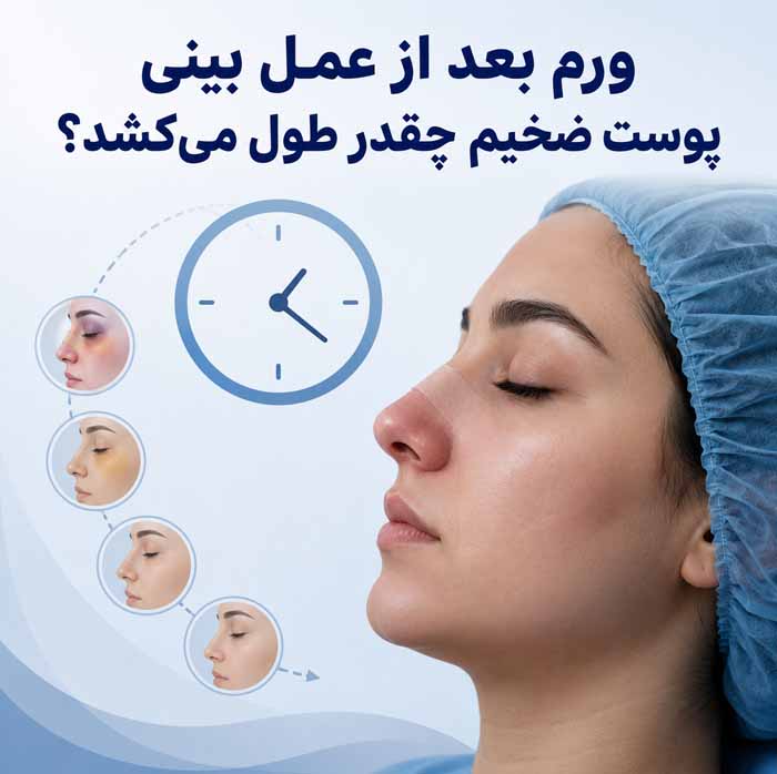 رینوپلاستی پوست ضخیم؛ نتیجه عمل بینی گوشتی و مدت ماندگاری ورم؛ مراقبتها و انتظارات واقعبینانه 4 ورم بعد از عمل بینی پوست ضخیم چقدر طول میکشد؟