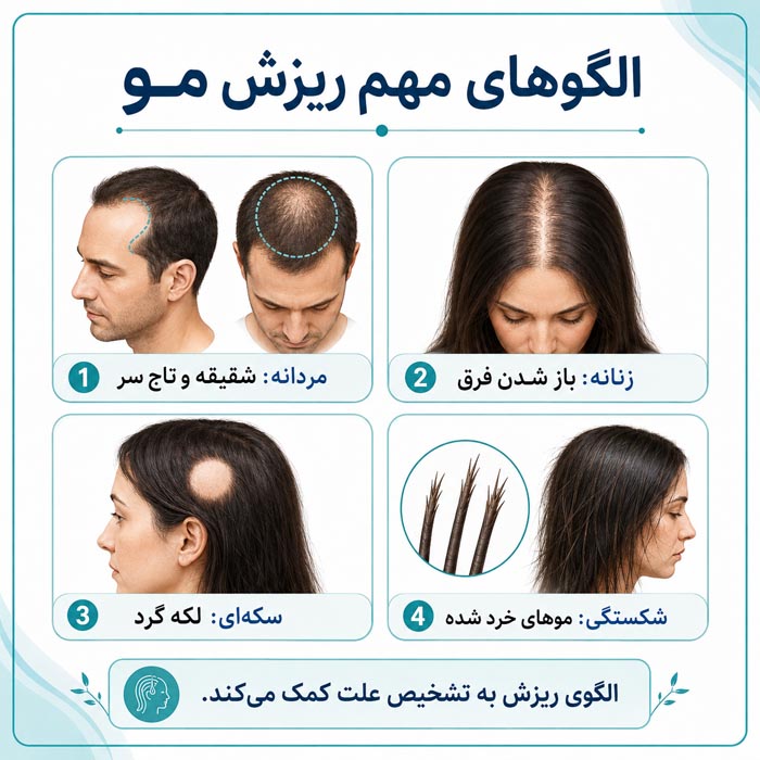 الگوهای ریزش مو