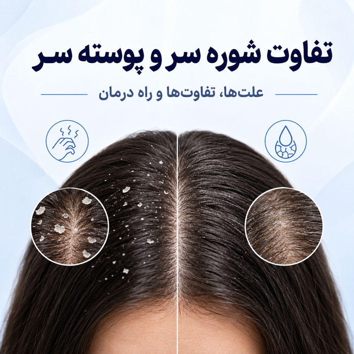 تفاوت شوره سر و پوسته سر؛ از تشخیص تا درمان درست هرکدام 1 تفاوت شوره سر و پوسته سر؛ از تشخیص تا درمان درست هرکدام