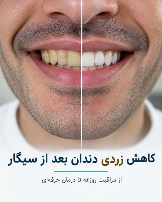 کاهش زردی دندان بعد از سیگار
