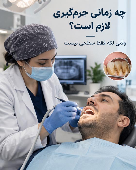 جرم گیری و لکه زدایی دندان