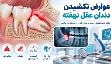 دندان عقل نهفته